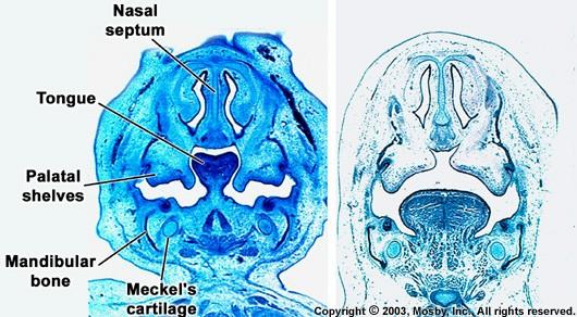 Vývoj nosní přepážky nosní přepážka vyrůstá z area triangularis - mezenchymová ploténka,