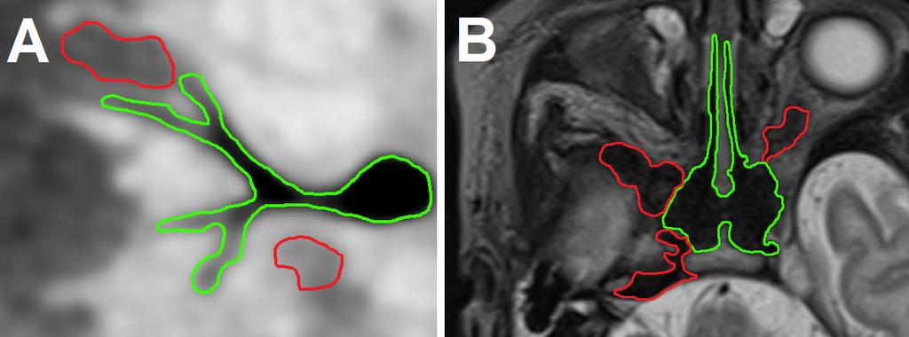 Fig. 6.6: Segmented airways: Green line - valid segmentation, Red line - Tissues or cavities which does not belong to the airways, but has similar intensity values.