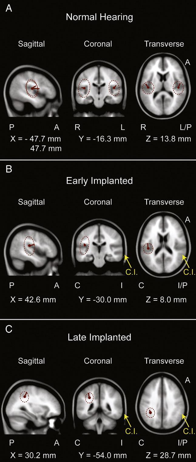 Vlevo jsou vidět odezvy u normálně slyšících osob (A), uprostřed (B) je vidět aktivita u implantovaných jedinců do dvou let věku a napravo je zobrazen naměřený výsledek P1 potenciálu u později
