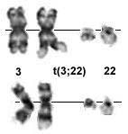 Obrázek 5: Parciální karyotyp translokace t(3;22)(q27;q11) u ABC DLBCL Převzato z: http://atlasgeneticsoncology.org/anomalies/3q27id2081.