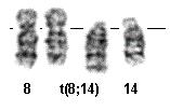Obrázek 8: Parciální karyotyp t(8;14)(q24;q32) u BL Převzato a