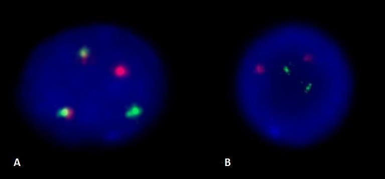 Obrázek 9 : Výsledek metody FISH na interfázních jádrech se sondou LSI IGH/BCL2 u DLBCL (převzato z HOK FNOL) A) přestavba genu BCL2 (fůze s genem IgH vytváří fůzní signál na obou chromosomech, na