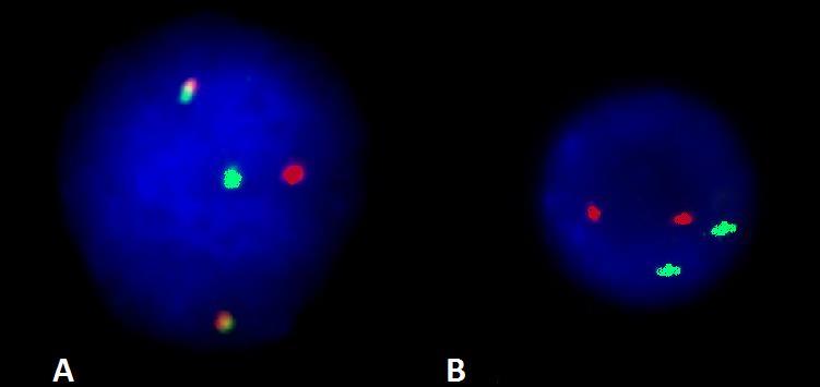 Obrázek 10: Interfázních FISH sondou LSI IGH/BCL2 u FL (převzato z HOK FNOL) A) přestavba genu BCL2(1R1G2F); B) normální nález pro gen BCL2 (2R2G) 5.2.3.