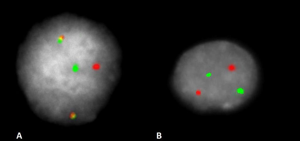 Obrázek 11: Výsledek metody FISH na interfázních buňkách kostní dřeně se sondou XL t(11;14) (převzato z HOK FNOL) A) translokace t(11;14) (1R1G2F); B) normální nález (2R2G) 5.2.4. Soubor pacientů s lymfomem marginální zóny MALT (MZL) Soubor tvořilo 6 pacientů s diagnostikovaným MZL.