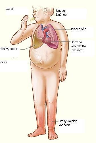 SRDEČNÍ SELHÁNÍ - skupina onemocnění charakterizovaná znaky srdeční nedostatečnosti konečné stádium onemocnění chlopní, po IM, pozánětlivě, kardiomyopatie - srdce selhává jako pumpa - klinické