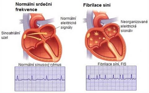 FIBRILACE SÍNÍ - nejčastější arytmie, hlavně u starších pacientů - nepravidelná a chaotická aktivita síní - projevy: může být zcela asymptomatická či příznaková (palpitace,