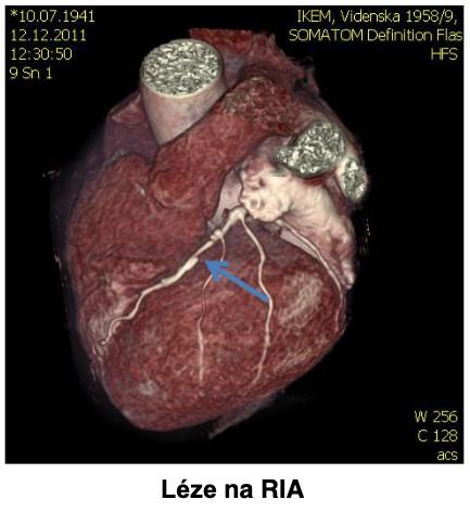 MR srdce CT srdce
