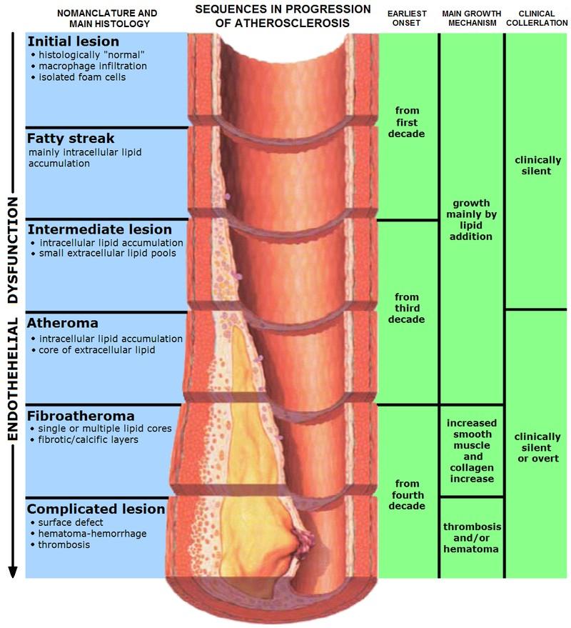 Vývoj aterosklerózy: 1. časná léze initial lesion, izolované pěnové bb 2.