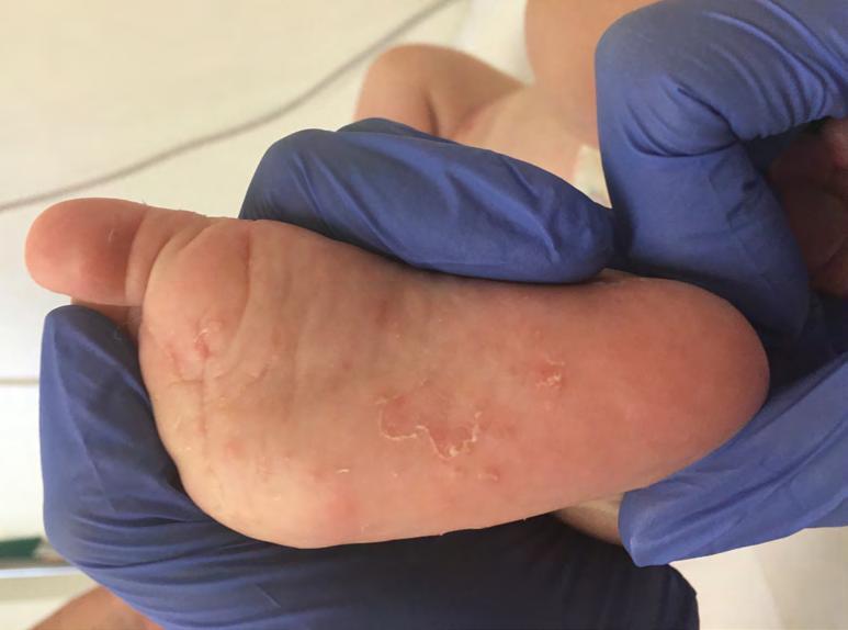 En coup de sabre (forma lineární sklerodermie chronické zánětlivé onemocnění kůže doprovázené zmnožením pojivové tkáně) Psoriasis capillitti (lupénka vlasové oblasti) Specializované dětské kožní