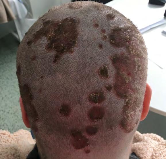 s. V ambulanci všeobecného dermatologa představuje dětský pacient pouze cca 5 10 % nemocných. Jelikož dítě není malý dospělý, má dětská dermatologie své nezastupitelné místo.