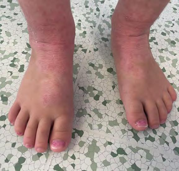 Atopická dermatitida akutní exacerbace kožními rýhami. Při akutním zhoršení kůže zčervená, jsou přítomny papulky, exkoriace (oděrky) po škrábání projevů.