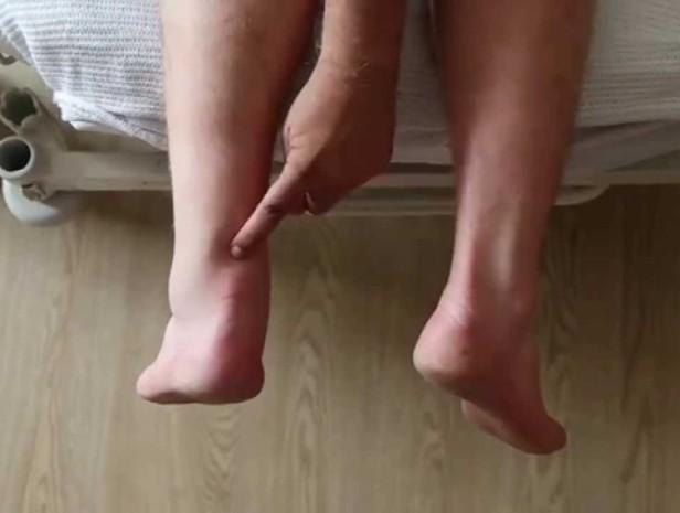 Poranění šlach Distenze natažení