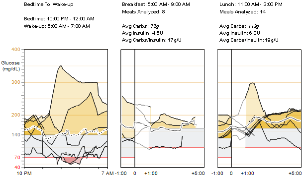 Glucose Sensor Overlay Bedtime-to-Wake-up and Meal Periods Readings and Averages (Porovnání hodnot glykemie naměřených senzorem doba od ulehnutí ke spánku po probuzení a doba jídla naměřené hodnoty a