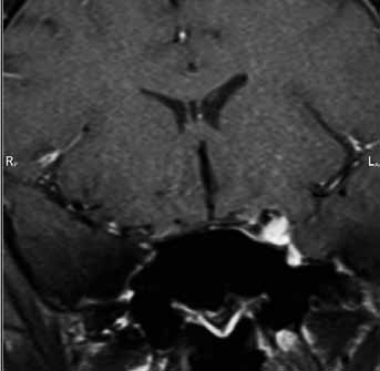 3D TOF MR angiografie prokazuje přítomnost dvou malých pseudoaneuryzmat lacerózního segmentu levé vnitřní karotidy v důsledku zánětlivé infiltrace oblasti hrotu pyramidy (vpravo). Fig. 19.