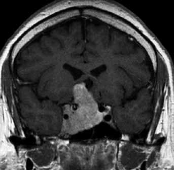 ACTH secreting pituitary 4 mm microadenoma, not directly visible on unenhanced T1 weighted image (left: only mild deviation of pituitary stalk to the left), well appreciated only on dynamic contrast