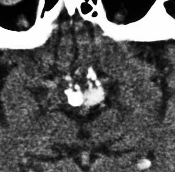 7. Multiple calcifications in a craniopharyngeoma located in the basal cisterns on a CT image Obr. 8.