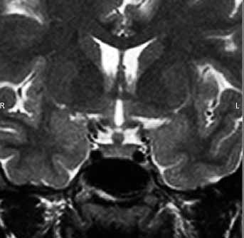 Extensive myxochondrosarcoma of the skull base, involving sellar and suprasellar areas, midlle and posterior fossa, paranasal sinuses, and left orbit on T2 weighted MR image.