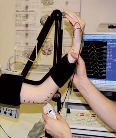 sval opouští pod aponeurózou mezi FCU a FDP (deep flexorpronator aponeurosis) a zde je třetí místo možné komprese (point of exit from the flexor carpi ulnaris).