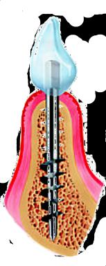 Jednalo se o implantáty značně složitých konstrukcí a tvarů, jejichž zavedení do lidské čelisti nebylo snadné