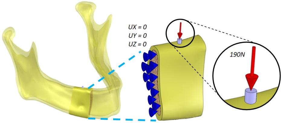 Model vazeb a zatížení Z hlediska spojení mezi implantátem a kostí jsou v celé práci uvažovány dva stavy.