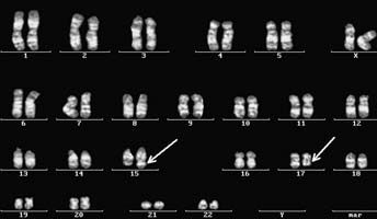 UŽITÍ ALL-TRANS-RETINOVÉ KYSELINY U AKUTNÍ PROMYELOCYTÁRNÍ LEUKEMIE VÍCE NEŽ ÚSPĚŠNÝ MODEL CÍLENÉ LÉČBY V HEMATOONKOLOGII Tomáš Szotkowski 1, Edgar Faber 1, Jan Starý 2, Jaromír Hubáček 1, Romana