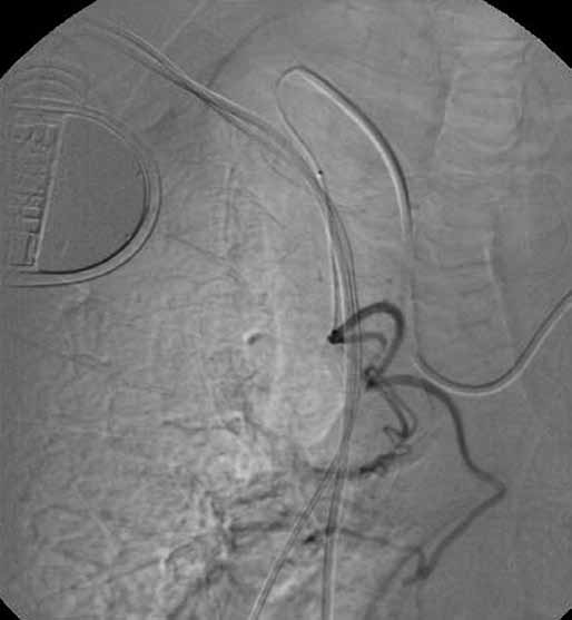 (na obr 2 C je vyplněna embolizační směsí), hvězdička a. thoracica interna dx. Fig. 2. Angiogram of the right subclavian artery before embolization shows anomalous bronchial artery arising from the internal mammary artery (A).