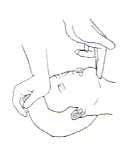 Krok 3 Postavte se za hlavu pacienta,zatáhněte jeho hlavu dozadu směrem k vám a táhněte bradu pacienta směrem vzhůru aby se otevřelo pacientovo hrdlo.