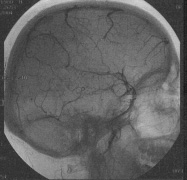 a b c Obr. 1. DSA, MRI + MR venografie Time of Flight-TOF. a) DSA (den 1) uzávěr sinus transversus, vena magna cerebri (Galen), vena cerebri interna a vena basalis Rosenthali.