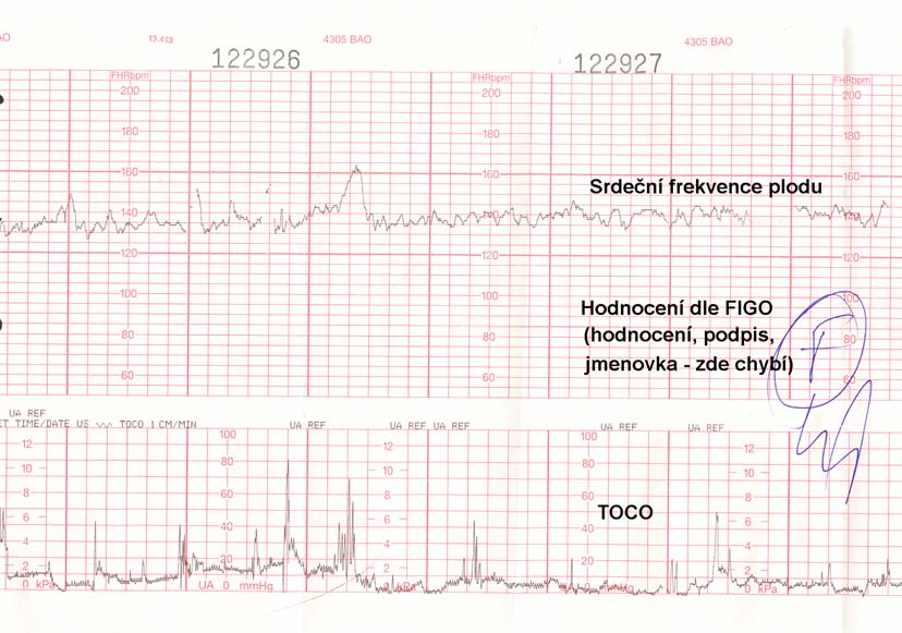 3: Fyziologický antepartální CTG záznam