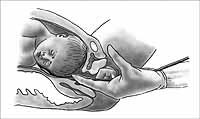 Obr. 6: Uložení detektoru pro intrapartální fetální pulsní oxymetrii Současné podmínky pro provedení intrapartální pulsní oxymetrie u plodu jsou těhotenství starší 35 týdnů, pravidelná děložní