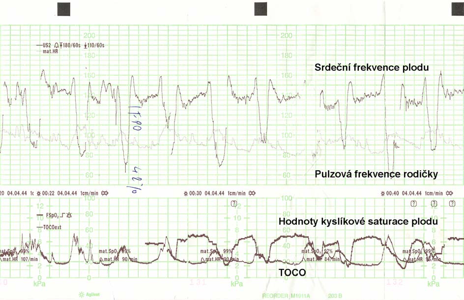 Obr. 7: CTG záznam - bazální frekvence 135 140 úderů/min., normální variabilita, hluboké DIP I (konec I.doby porodní).