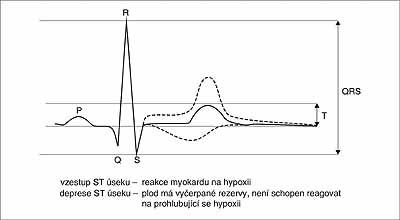 9: Změny elektrokardiogramu plodu v průběhu hypoxie: vzestup úseku ST - reakce myokardu na hypoxii, deprese úseku ST - plod má vyčerpané rezervy, není schopen reagovat na prohlubující se hypoxii