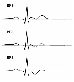 Obr. 10: Stupně bifázicity úseku ST: BP1 - negativní úsek ST s převahou nad bazální linií, BP2 - negativní úsek ST částečně protínající bazální linii, BP3 - deprese úseku ST pod bazální linií EKG