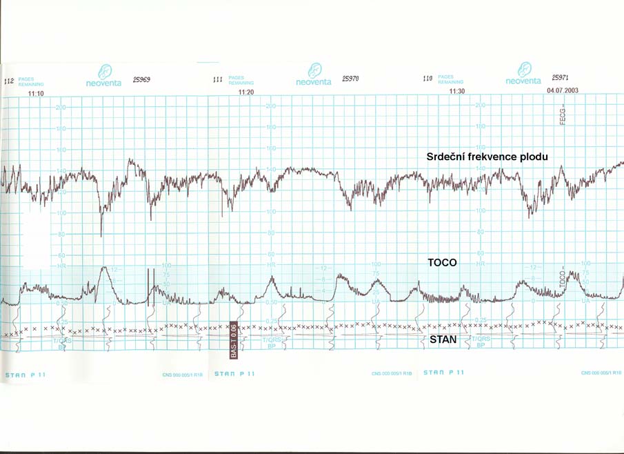 Obr. 11: Záznam STAN CTG s BF 130-140 úderů/min., undulatorní oscilační pásmo, mělké DIP I (amplituda cca 30 úderů/min.).