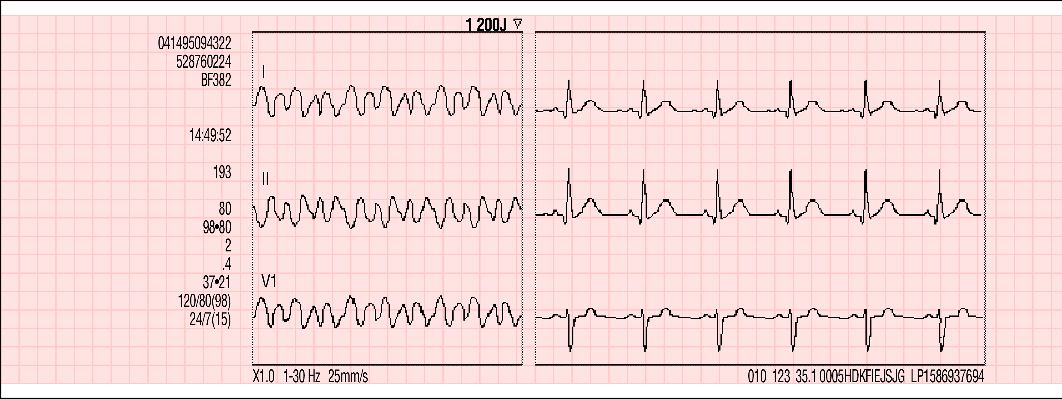 *Hodnota impedance pacienta (v ohmech) se zobrazuje ve zprávách o výbojích, jsou-li použity jednorázové defibrilační elektrody.