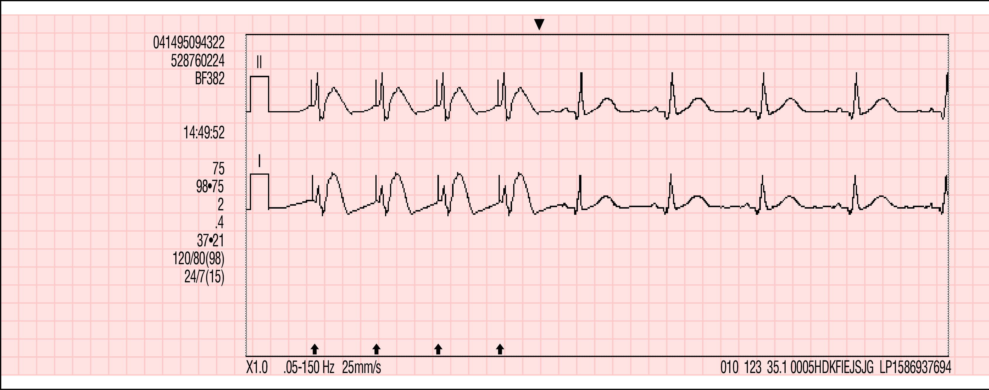 Obrázek 7-3 Příklady výtisků událostí spojených s křivkami Kapacita paměti Monitor/defibrilátor LIFEPAK 15 zachová údaje o dvou nebo více pacientech i po vypnutí napájení nebo vyjmutí baterií.