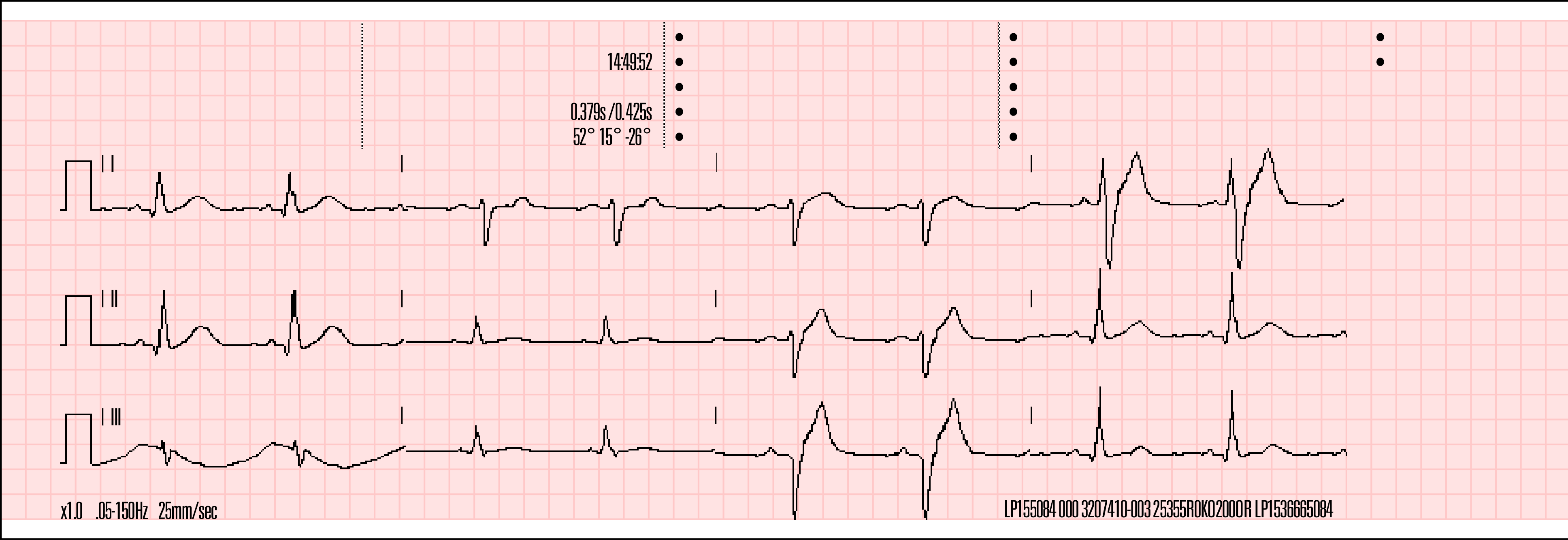 3kanálový formát 3kanálový formát tiskne 2,5 sekundy dat pro každý svod. Obrázek 4-7 znázorňuje příklad zprávy o 12svodovém EKG vytisknuté ve 3kanálovém formátu za použití standardního stylu.