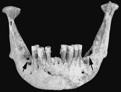 Třeboradice, feature No. 3. Skeleton No. 1, mandibula. Degree of abrasion does not correspond to maxilla. Intravitally lost 36, 37 and 47 (indicate by arrows). Tartar deposit on incisors.