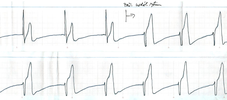 Kazuistika Obr. 3 EKG křivka č.