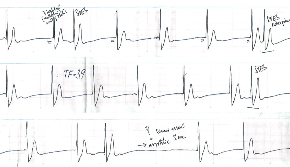 Kazuistika Obr. 4 EKG křivka č.