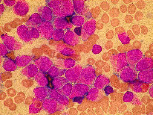 Diagnózy s potřebou alogenní transplantace krvetvorby akutní myeloidní leukémie akutní