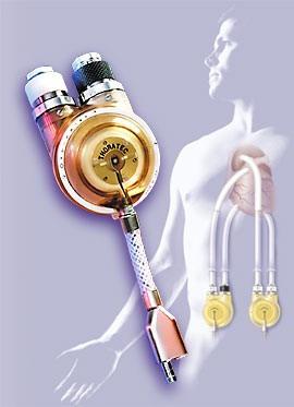 Mechanická podpora srdce záměry implantace 100 90 80 70 60 50 40 30 20 10 0 78% 12% OHTx =