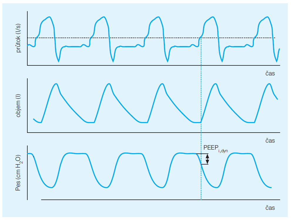 Aby došlo k zastavení exspiračního průtoku dýchacími cestami, musí nemocný aktivním inspiračním úsilím vyrovnat alveolární tlak v daném okamžiku.