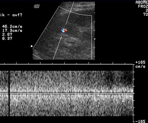 AVF a pseudoaneurysma Malá AVF PSA