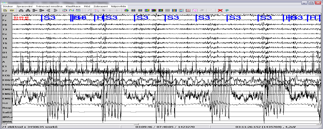 Komplikace při zpracování EEG - o pacientech často nemáme žádné dodatečné informace - bez lékaře