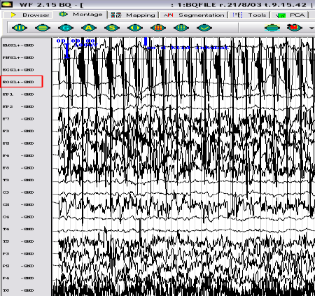 Komplikace při zpracování EEG Neúplná data - některé kanály občas chybí -