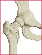 MD-HIP Klinické indikace Osteoartróza kyčelního kloubu Zánět pouzdra kyčelního kloubu Revmatoidní artritida kyčelního kloubu