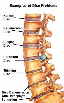 Degenerativní kaskáda : Difuzní vyklenutí /bulging, prolaps disku/ Výhřez /herniace/ meziobratlového disku - protruze -