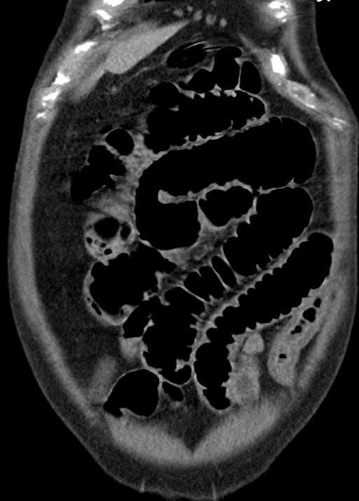 low-grade ileus a