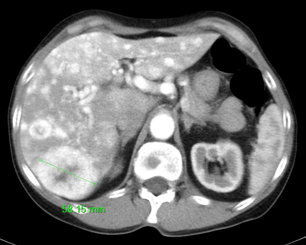 Kazuistika: karcinom pankreatu vs pnet Srpen 2007 Od 2/2007 Sandostatin LAR 30mg 3/2007 snížena